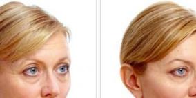 "مادونا ليفت" الأقوى في عالم تجميل البشرة وشدها !