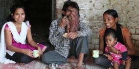 "الرجل الفيل".. الفقر وحده جعل حالته تتفاقم