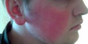 بريطانيا تطرح "جل" جديدا يتميز بمفعول سحري لعلاج احمرار الوجه