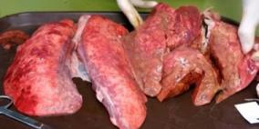 بالفيديو.. لقطات كارثية توضح شكل الرئة عقب تدخين 60 سيجارة فقط