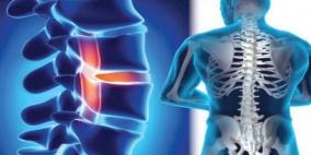 التدخين يتسبب بأمراض خطيرة في العمود الفقري