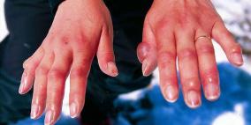 عضة الصقيع حالة علاجها قد يكون البتر