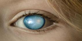 وجود مياه بيضاء على العين تؤدي لفقدان البصر 