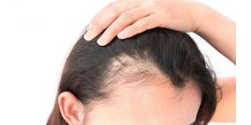 5 بدائل طبيعية لمحاربة تساقط الشعر