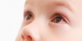 إحمرار العيون عند الأطفال..أسباب وعلاجات