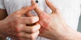 الأمراض الجلدية الأكثر شيوعاً في الصيف
