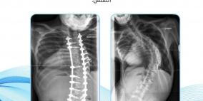 خاص| بالفيديو: أسباب تشوهات العمود الفقري وطرق الوقاية والعلاج