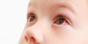 احمرار جفن العين عند الأطفال الرضع