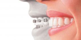 5 نصائح مهمة لتخفيف آلام تقويم الأسنان