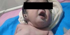تفاصيل ولادة ووفاة طفل بحالة نادرة في مصر