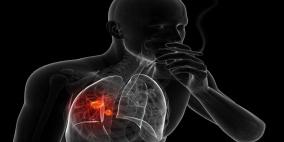  الصحة: 70% من مرضى سرطان الرئة في فلسطين من المدخنين 