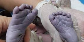 ولادة طفلة عراقية بــ 24 إصبعاً