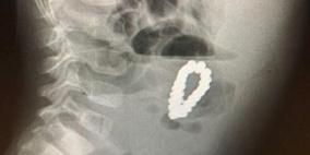 أطباء يعثرون على 18 قطعة مغناطيس في بطن طفل (شاهد)