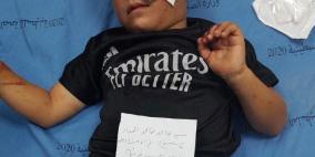 إصابة طفل بحروق في هجوم للمستوطنين على مسافر يطا