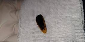 صور| مجمع ناصر الطبي بغزة يستخرج بذرة عباد شمس من حلق طفلة ويُنقذ حياتها