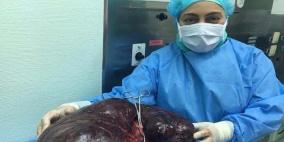 إزالة ورم يزن 17 كيلوغرام من بطن امرأة إماراتية