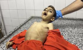 سلاح التجويع الإسرائيلي يقتل طفلا في غزة