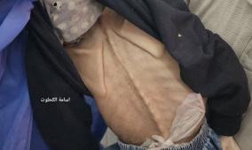 غزة: 3 وفيات بالتجويع آخر 24 ساعة والحصيلة ترتفع إلى 162 شهيدا