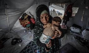11 حالة وفاة نتيجة المجاعة وسوء التغذية في غزة