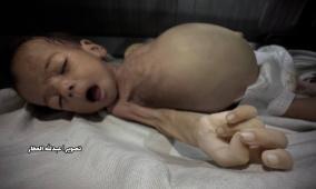 الأمم المتحدة تطالب بعمل دولي عاجل لوقف الوفيات في غزة