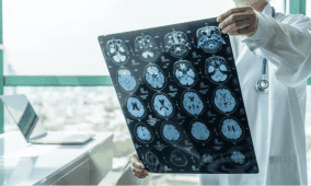 تقدّم طبي لافت.. قطرات أنفية لعلاج سرطان خطير