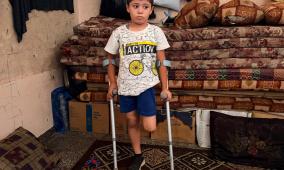 قصة مصورة| أحمد.. إصابةٌ كان يمكن علاجها فانتهت ببتر ساقه