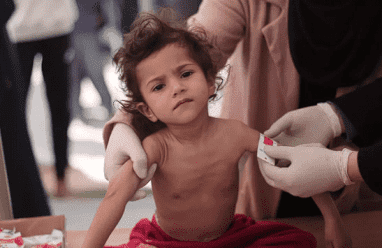  ارتفاع غير مسبوق بمعدلات سوء التغذية في غزة