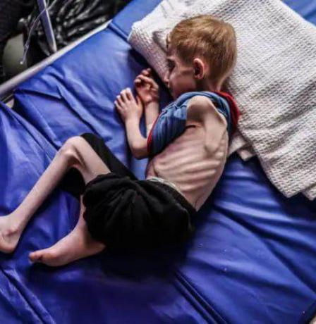 "أطباء بلا حدود": التقييد المتعمّد للغذاء والمساعدات أدى إلى مستويات مقلقة من سوء التغذية في غزة