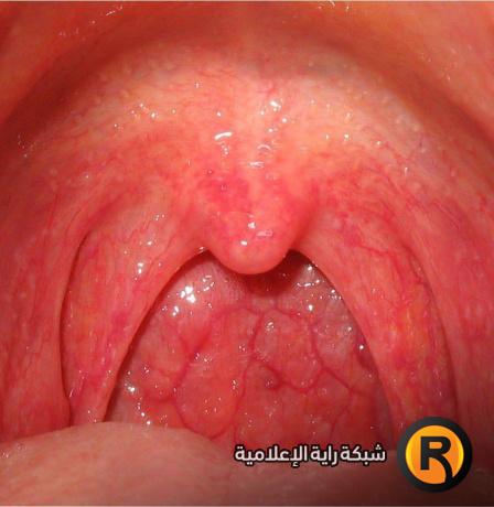 ما هو علاج احتقان الحلق؟