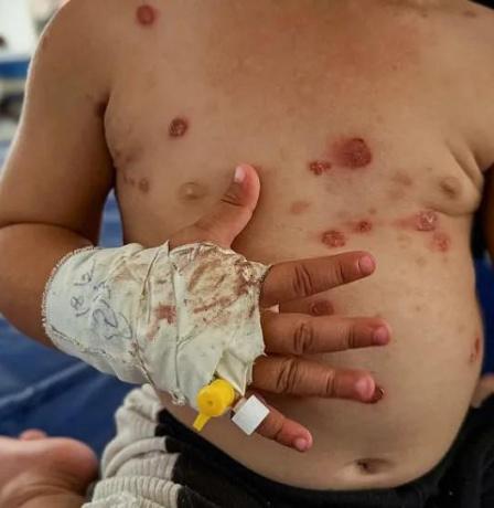 الأمم المتحدة تُحذر من تفشٍ واسع لـ "جدري الماء" يُهدد النازحين في قطاع غزة