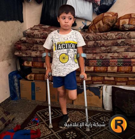 قصة مصورة| أحمد.. إصابةٌ كان يمكن علاجها فانتهت ببتر ساقه