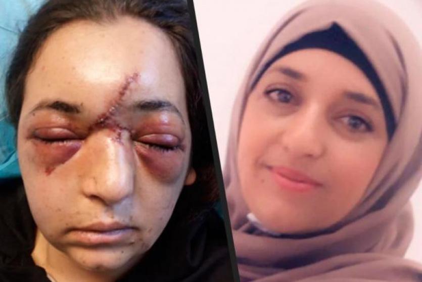 رينا درباس قبل وبعد الاعتداء