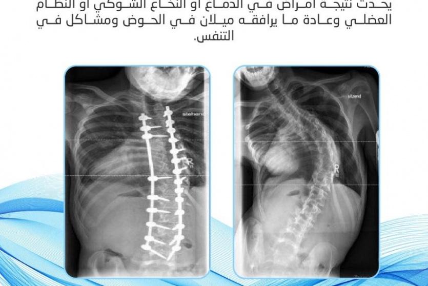 من أنواع التشوهات في العمود الفقري