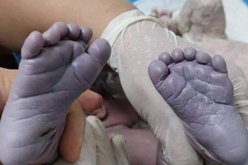 ولادة طفلة عراقية بــ 24 إصبعاً