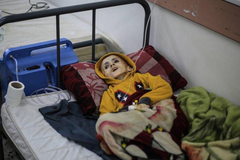 طفل يعاني بسبب المجاعة وسوء التغذية