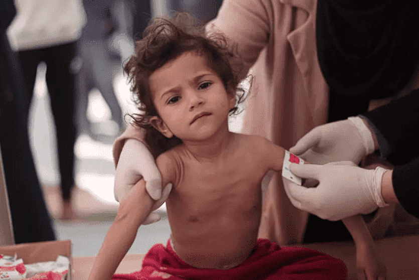 أطفال غزة يعانون سوء التغذية
