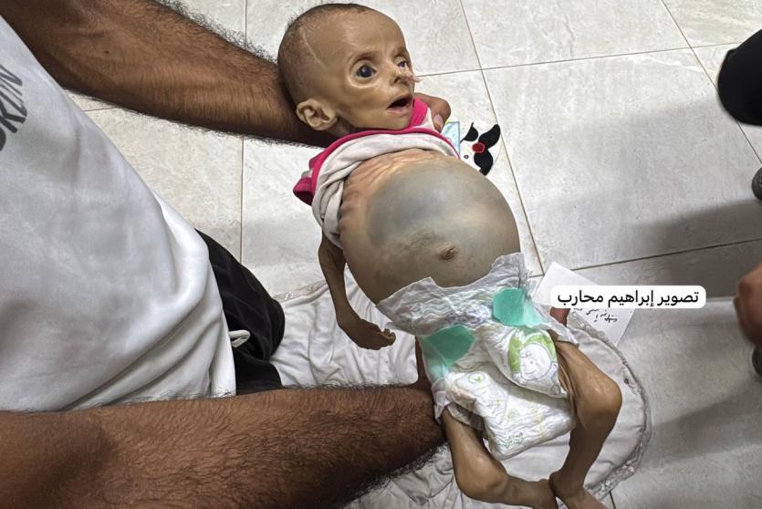 وفاة طفل جراء الجوع في غزة