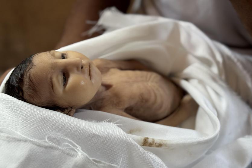 طفلة توفيت جراء سوء التغذية والمجاعة في غزة
