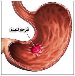 شبكة راية الإعلامية النظام الغذائى لمرضي قرحة المعدة