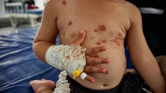 9300 إصابة بالمرض خلال أسبوعين