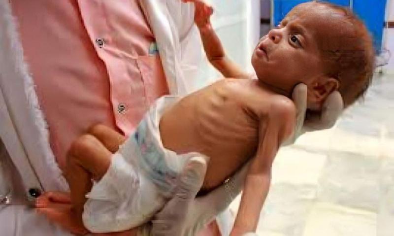 440 شهيدا بسبب التجويع من بينهم 147 طفل